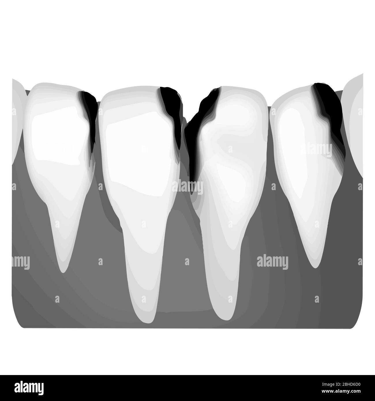 Dental caries. Xray of tooth decay. Caries infographics. Vector