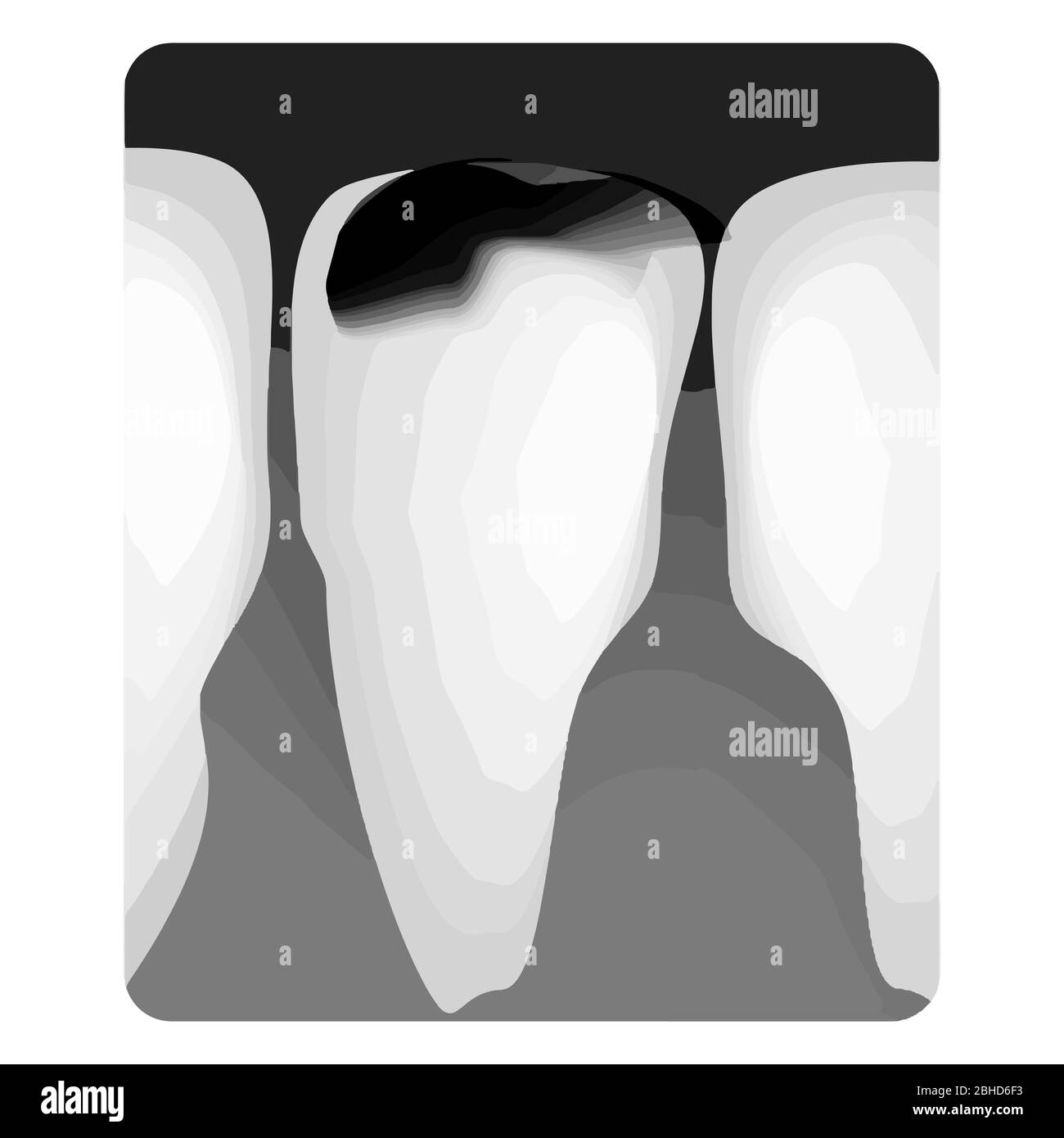 Dental caries. Xray of tooth decay. Caries infographics. Vector