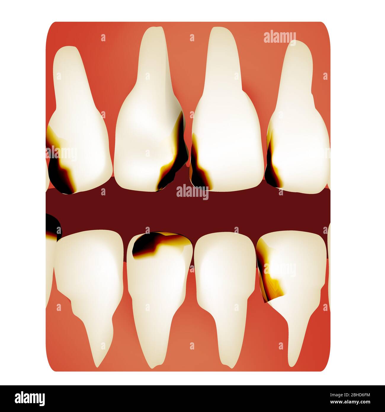 Dental caries. tooth decay. Caries infographics. Vector illustration on