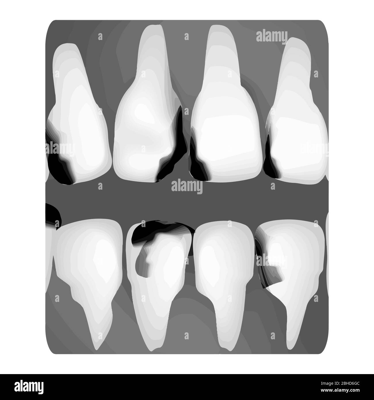 Dental caries. Xray of tooth decay. Caries infographics. Vector