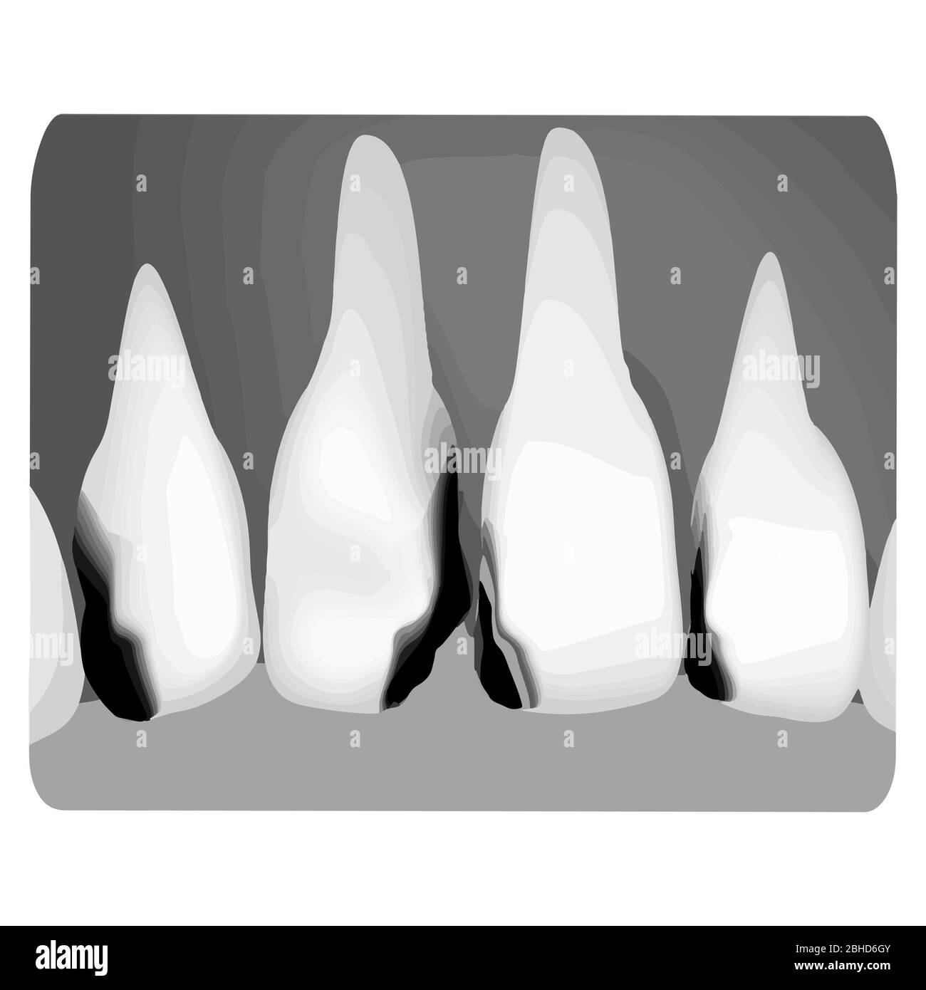 Dental caries. Xray of tooth decay. Caries infographics. Vector