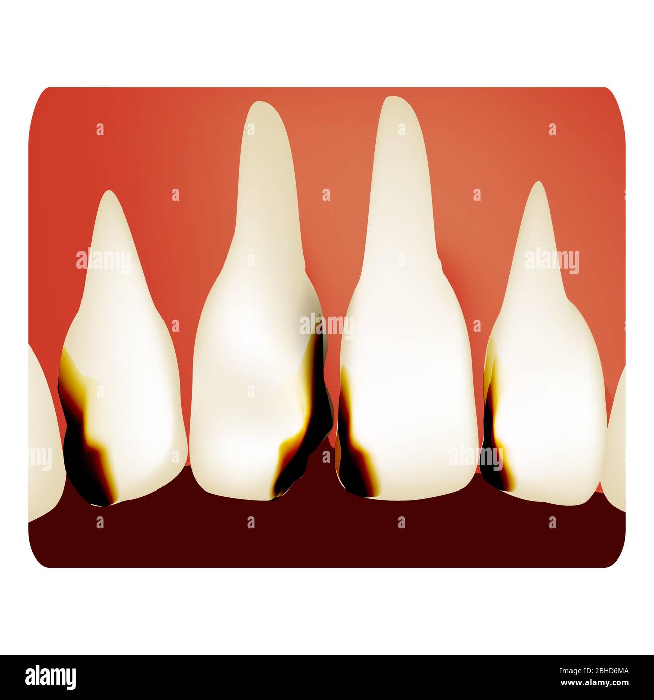 Dental caries. tooth decay. Caries infographics. Vector illustration on ...
