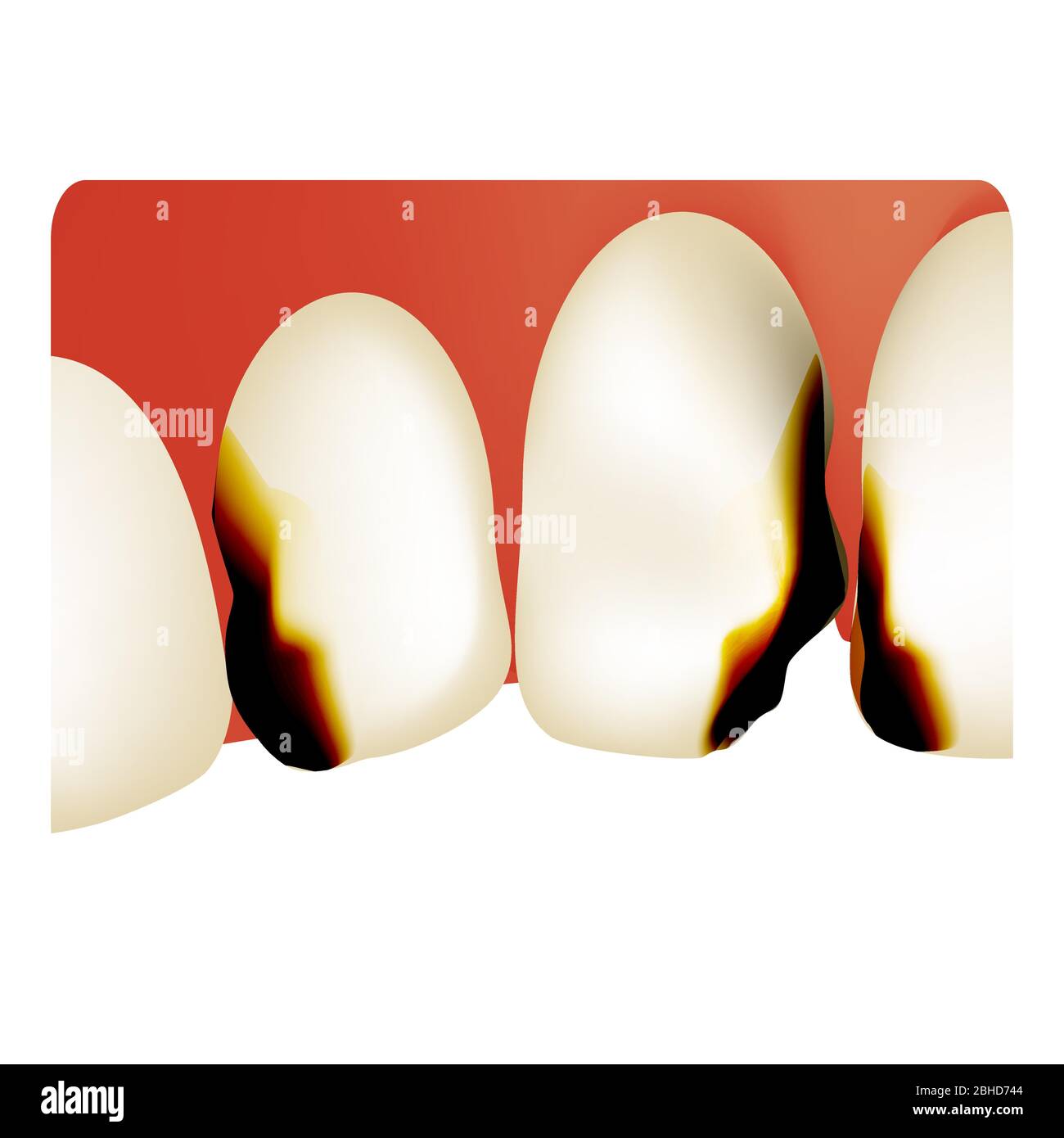 Dental caries. tooth decay. Caries infographics. Vector illustration on ...