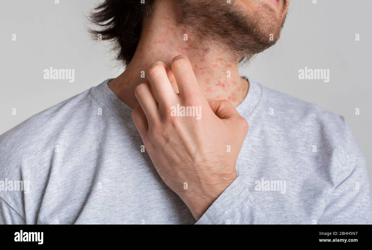 Eczema and itching concept. Red spots on skin Stock Photo