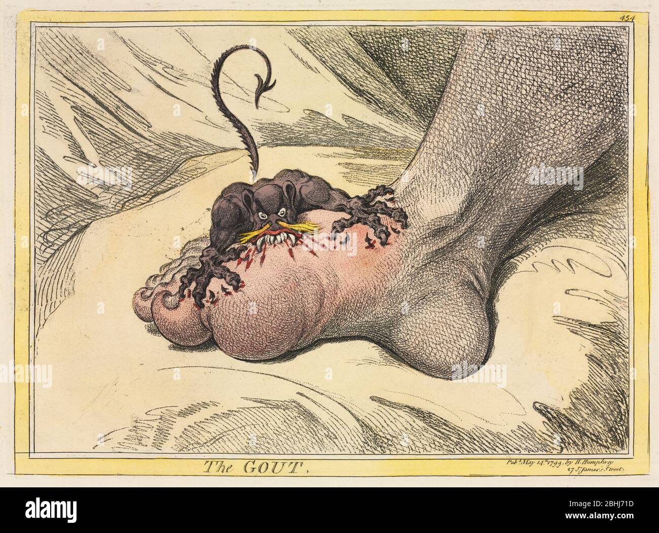 The Gout 1799 by James Gillray (British, 1757-1815) published by Hannah Humphrey England, 18th century Etching hand-colored with watercolor on Wove paper. A devil figure is shown biting into painful and inflamed toe joints. Gout is a metabolic condition where uric acid crystals are deposited in the joints, causing great pain. The big toe is the joint most commonly affected. The main causes are genetic factors and diet. Stock Photo