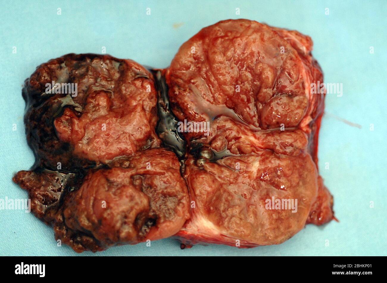 Close-up of an excised goitre (enlarged thyroid gland). Stock Photo