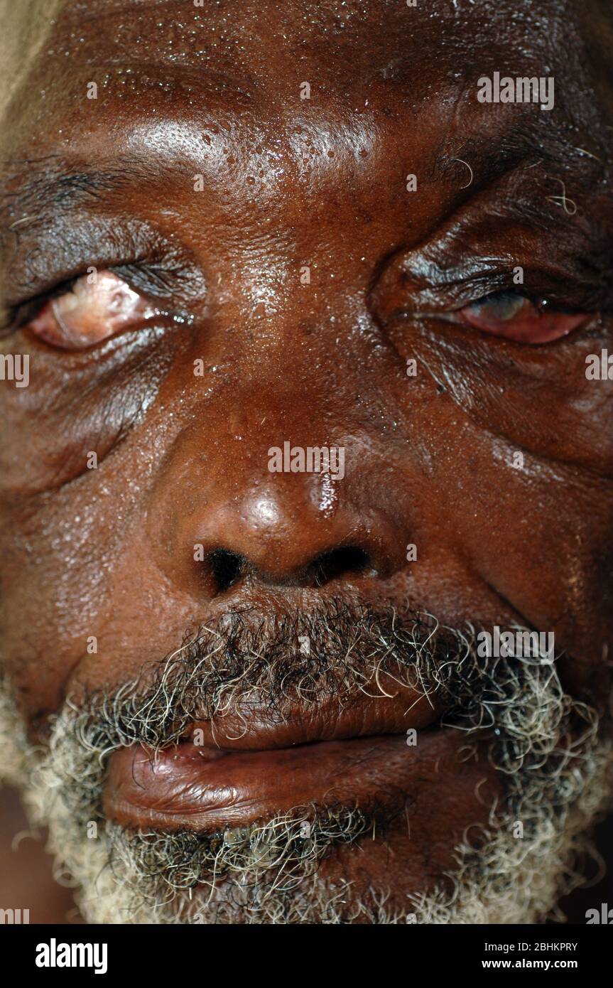 The mutilated eyes of an elderly man suffering from leprosy. Leprosy (Hansen’s disease) is a chronic infectious disease caused by Mycobacterium leprae Stock Photo