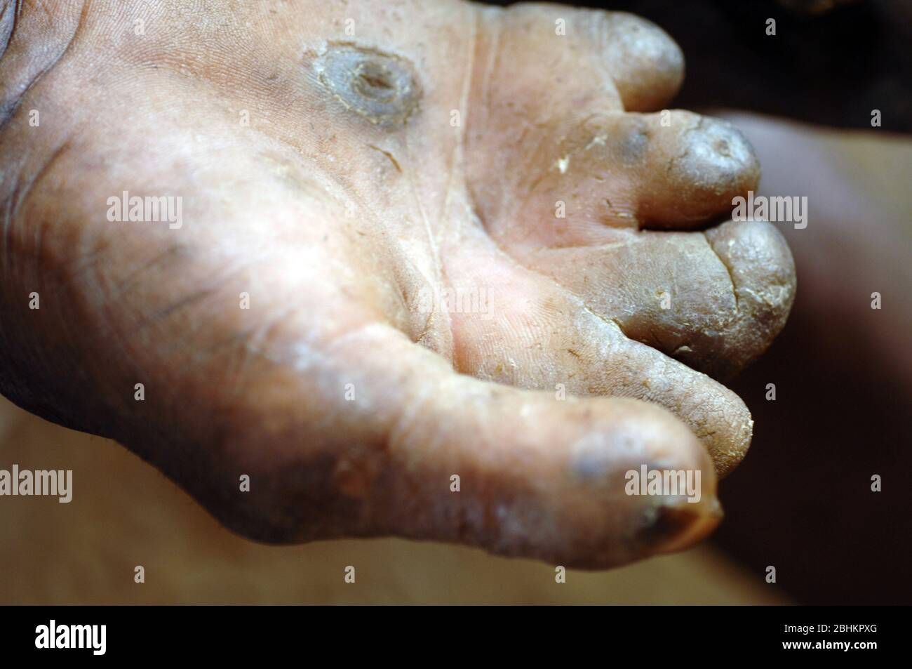 The mutilated hands of an elderly man suffering from leprosy. Leprosy (Hansen’s disease) is a chronic infectious disease caused by Mycobacterium lepra Stock Photo