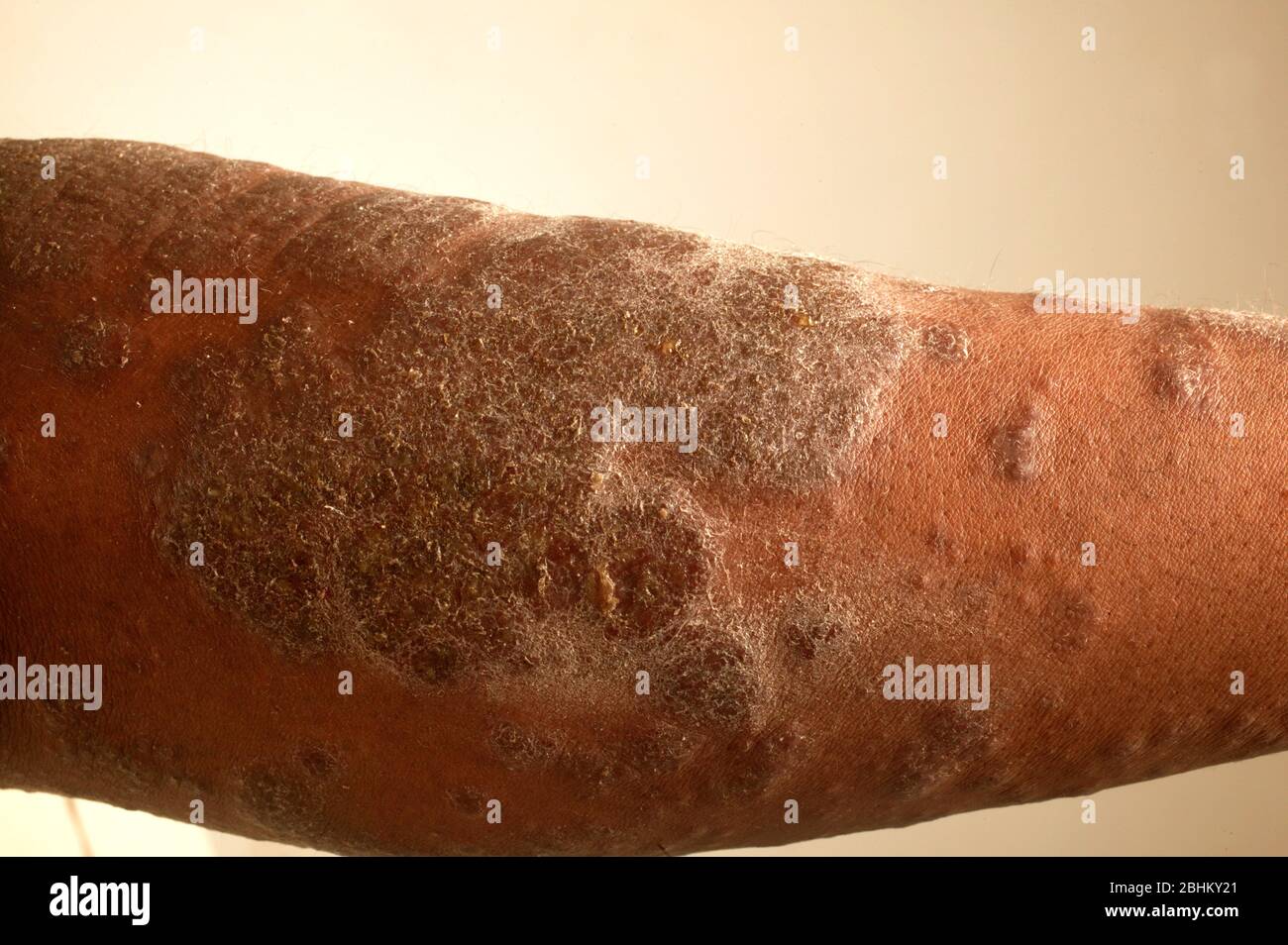 Arm with an unknown skin lesion. Stock Photo