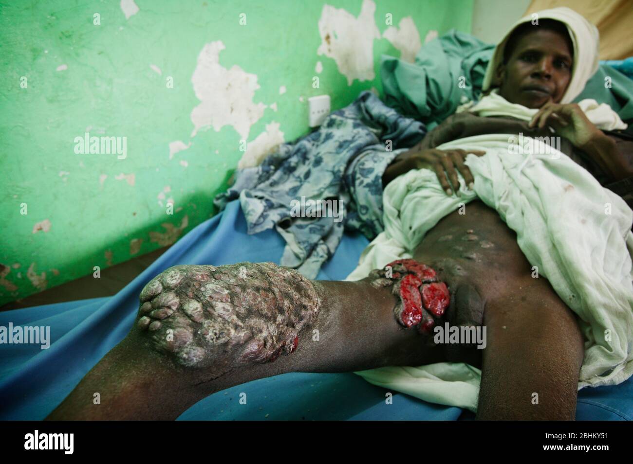 Mycetoma on the groin area and upper leg of a young male adult.  Mycetoma is an uncommon disease found in the tropics. It is a chronic, localised infe Stock Photo