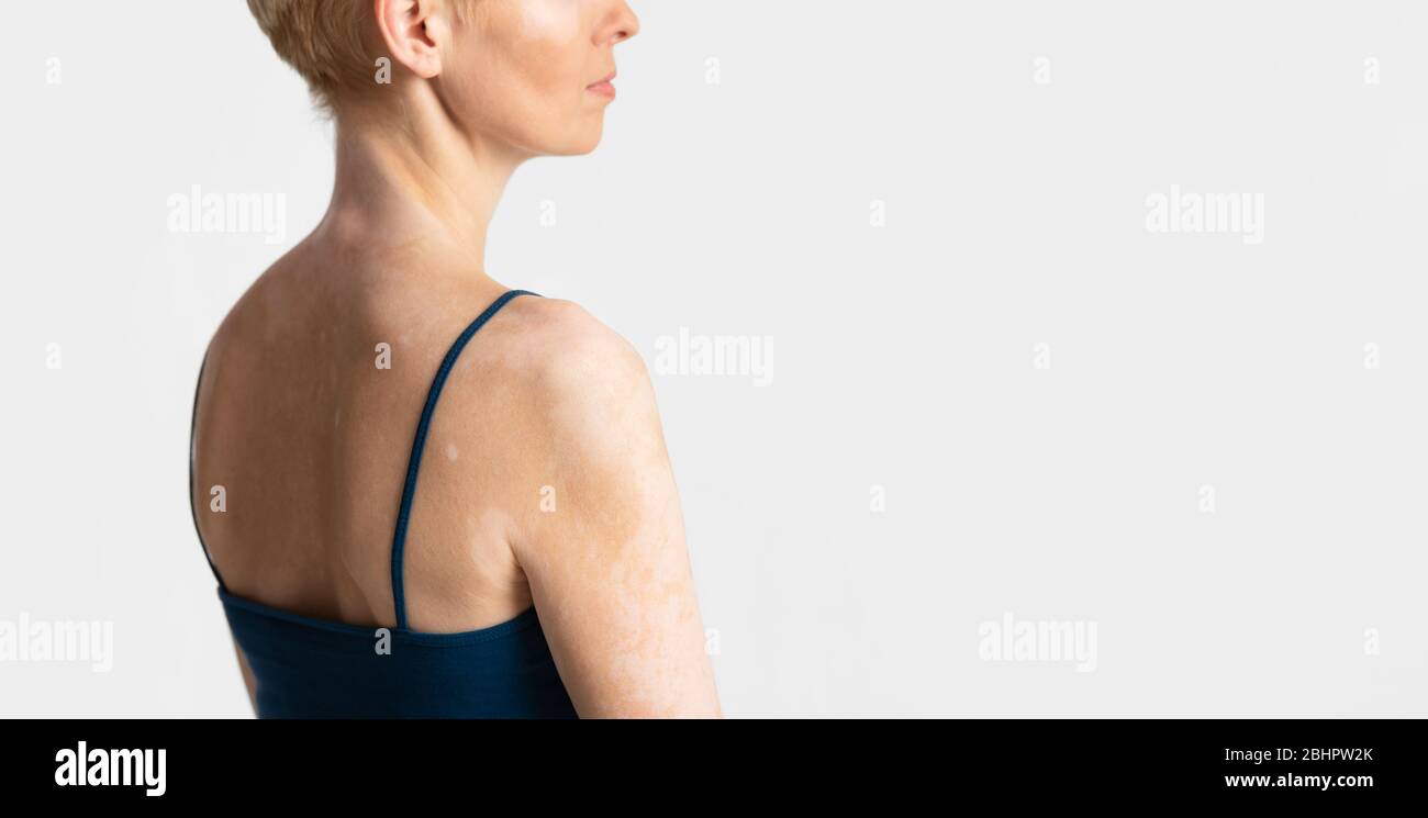 Acceptance of oneself with chronic disease, profile Stock Photo - Alamy