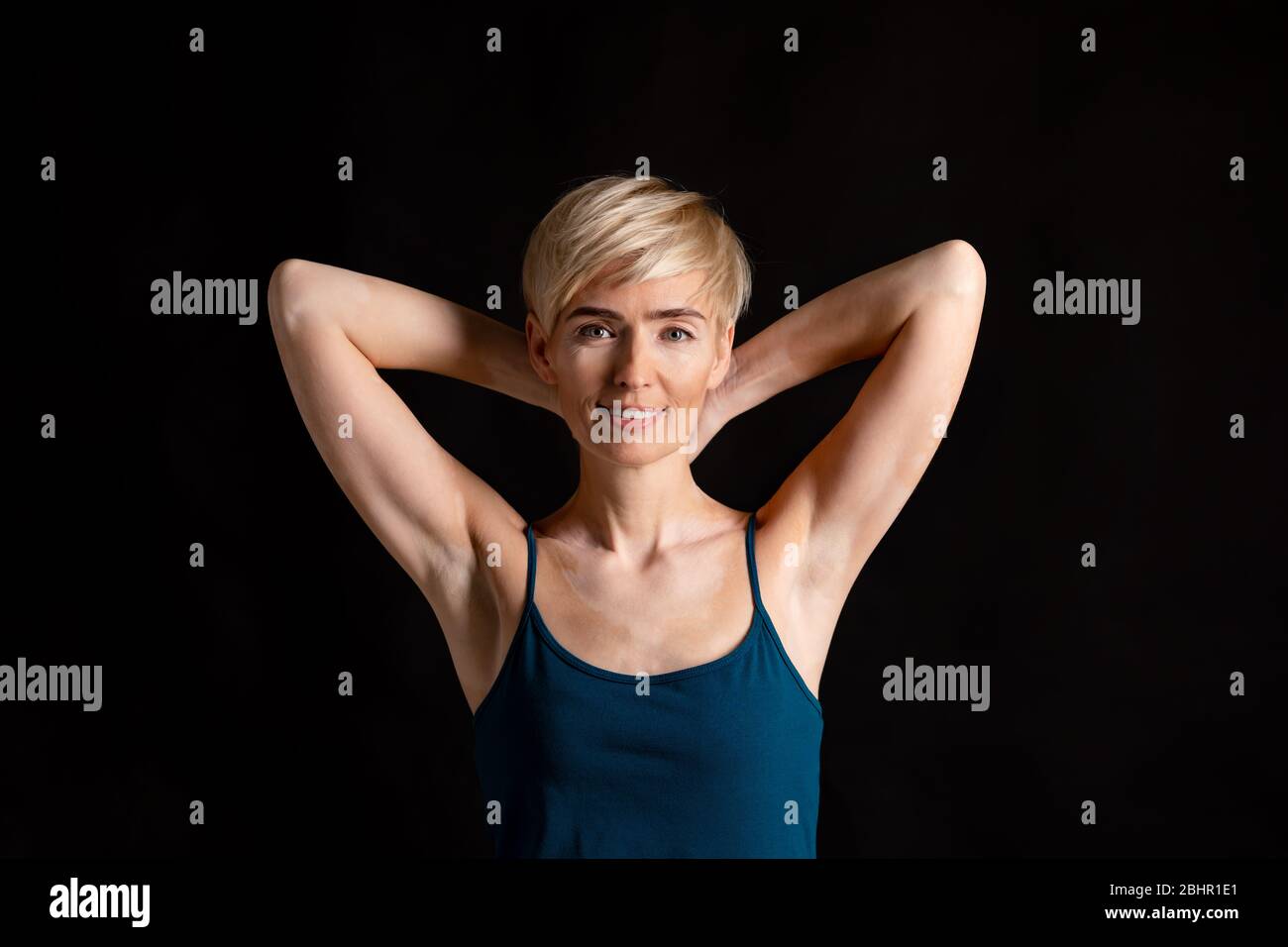 Distinctive feature. Woman with spots on body Stock Photo
