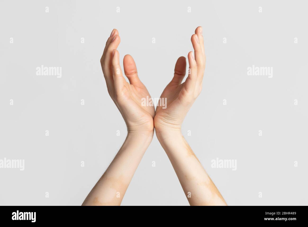 Chronic skin disease. Female hands with vitiligo spots Stock Photo