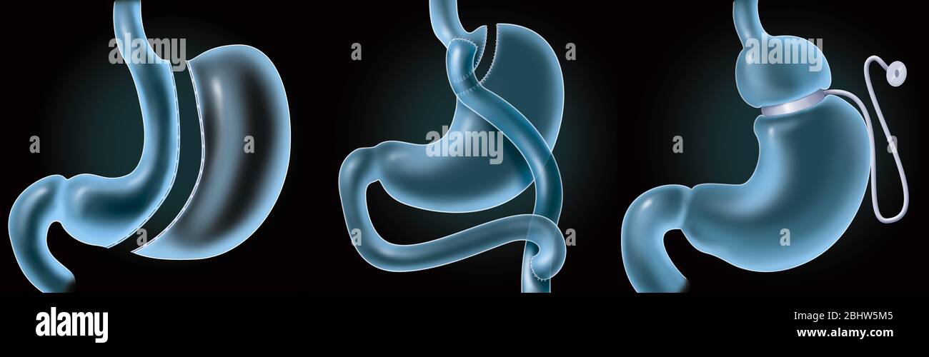Medical illustration representing 3 types of bariatric surgery to fight overweight and obesity: sleeve gastrectomy, bypass, gastric band. The sleeve ( Stock Photo