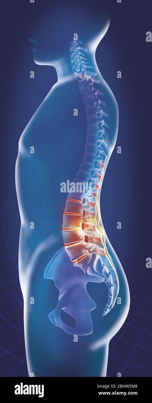 Representation of the spine with evidence of the lumbar spine. The 5 lumbar vertebrae, the 5 intervertebral disks, the interspinous muscles and the su Stock Photo