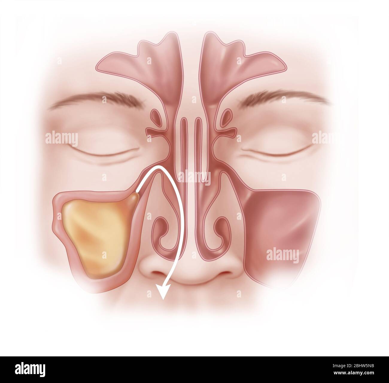 Sinusitis of the right maxillary sinus. The sinus is filled with mucus and the wall is inflamed and thickened. The different para-nasal sinuses are al Stock Photo