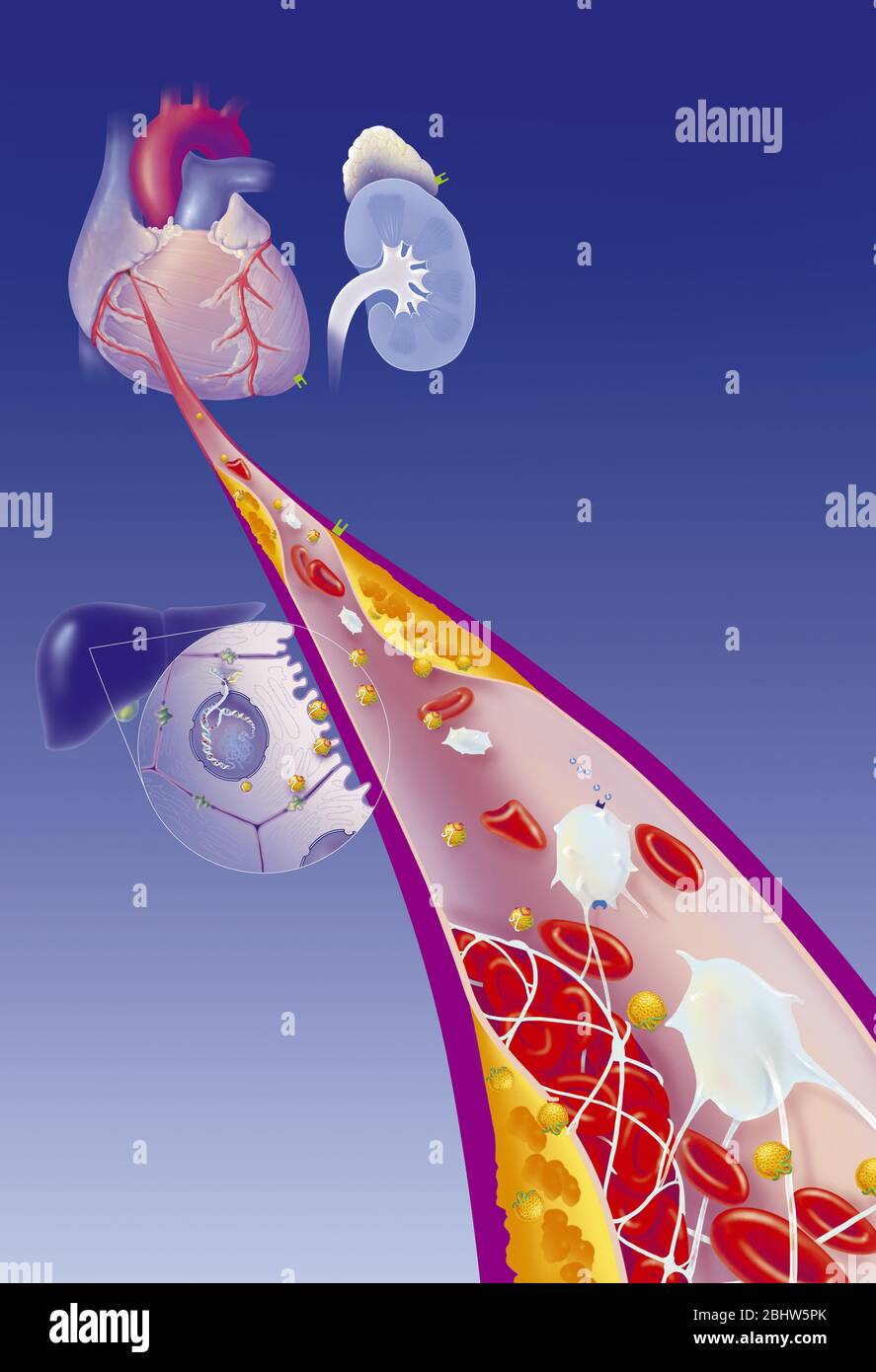 Myocardial infarction, coronary artery with thrombus, atheromatous