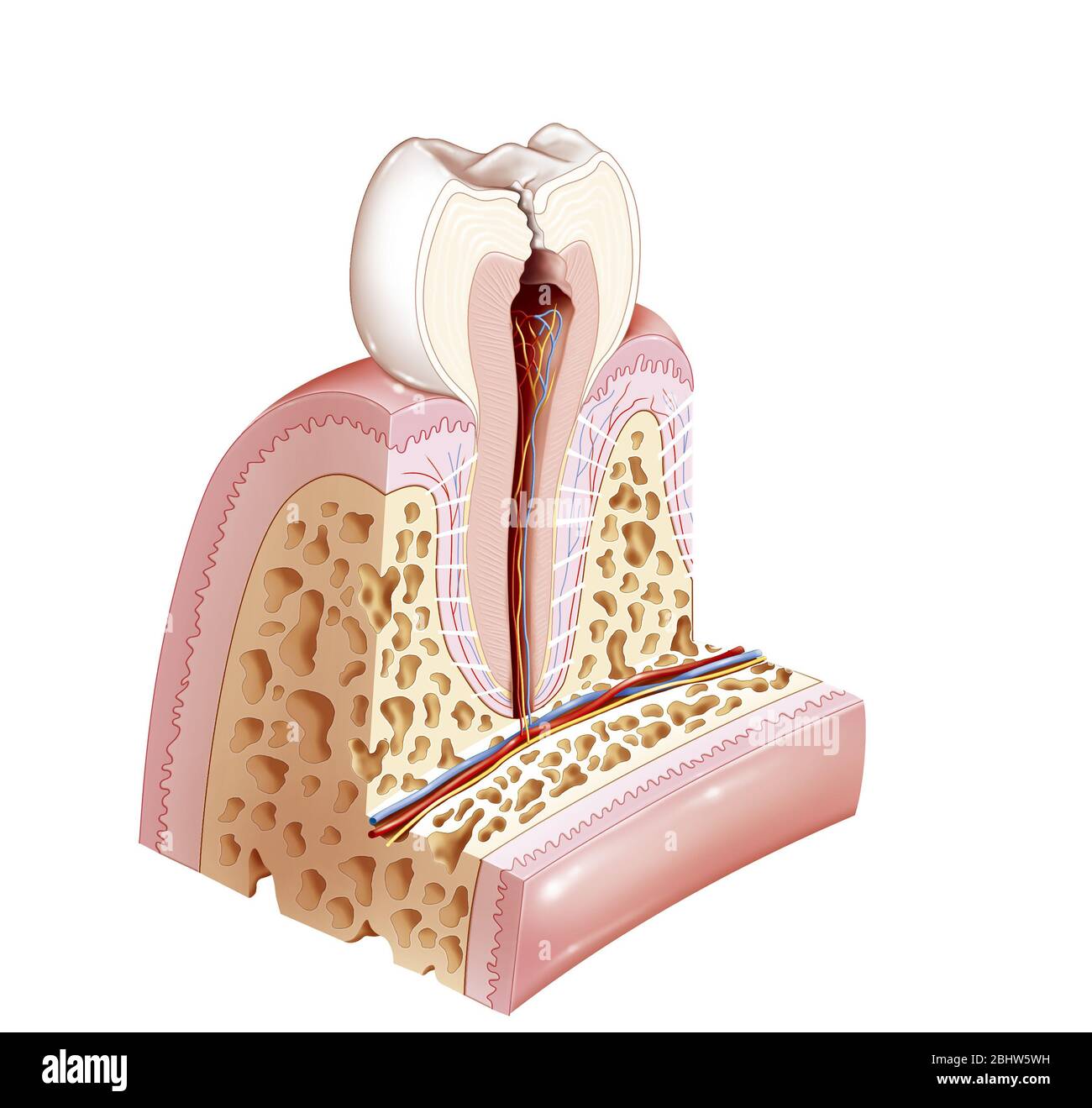 Dental pathology with caries reaching the pulp. The pulp is the central area of the tooth, the endodont. She is shown here in reddish brown. It is als Stock Photo