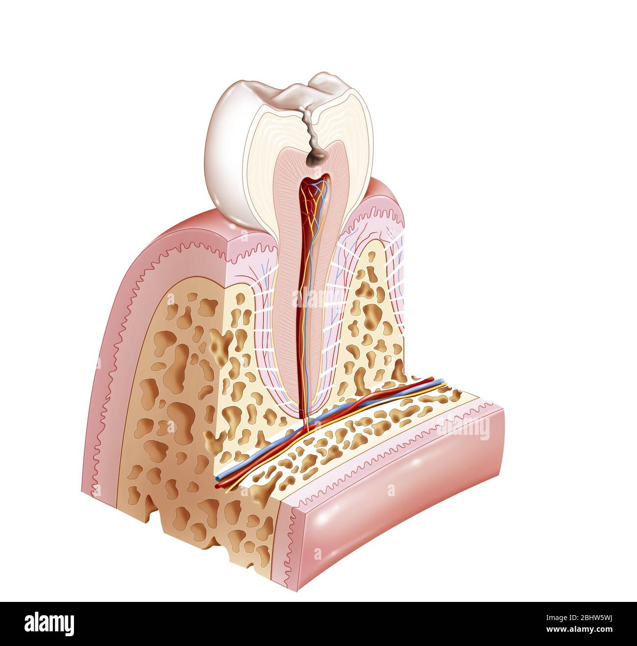 Decayed tooth with dentin damage. Dentin is the area shown in pinkish beige. Here we are in stage 2 of the tooth being affected by tooth decay. This i Stock Photo