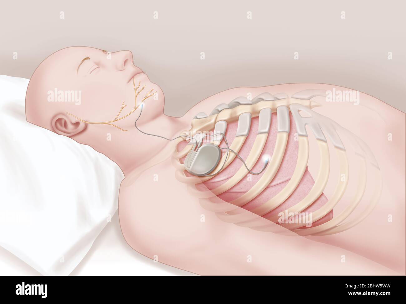 Sleep apnea treatment. A pacemaker is implanted under the collarbone connected to two electrodes, one to the hypoglossal nerve at the level of the ton Stock Photo