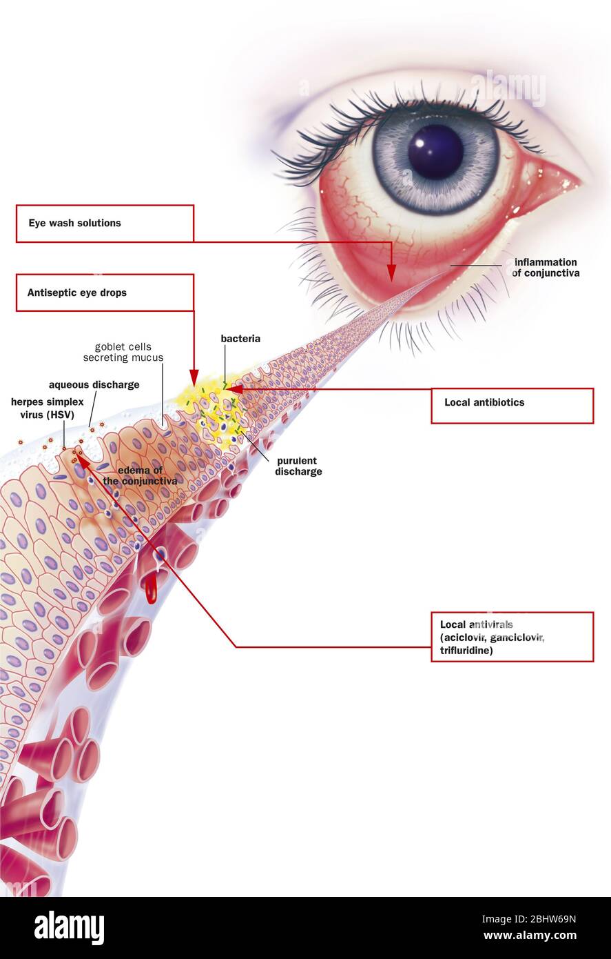 Infectious conjunctivitis and its treatments. View of an eye with inflammation of the conjunctiva. Zoom on the conjunctiva with from top to bottom 1 b Stock Photo