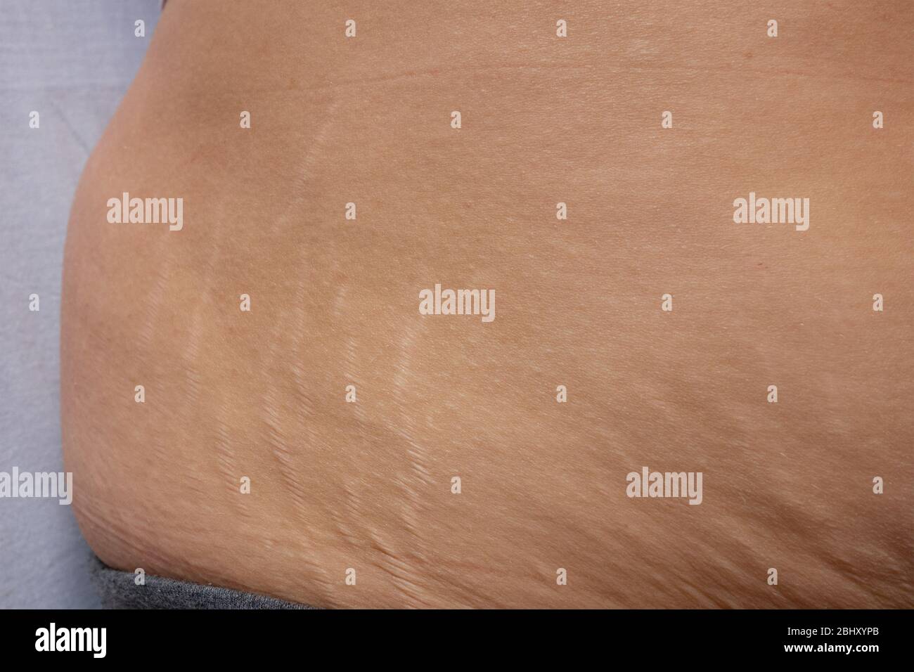 Postnatal changes as stretches on skin. After birth marks on belly of woman. Close-up view of postpartum stretches or age skin recovery Stock Photo