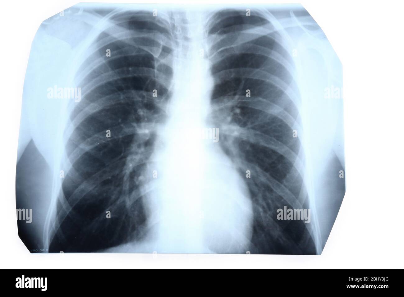 Chest x ray Cut Out Stock Images & Pictures - Alamy