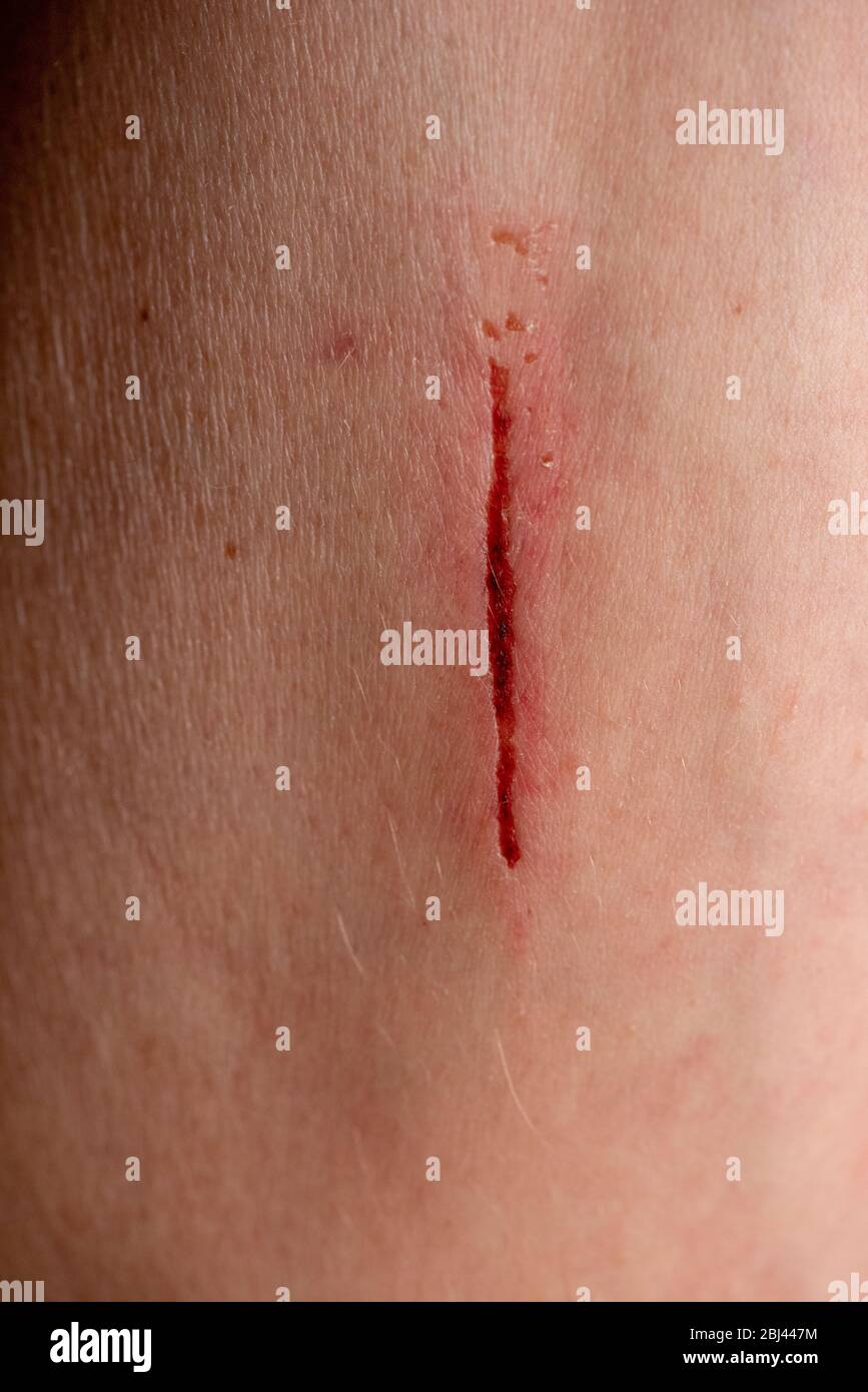 Scar with blood on a man arm Stock Photo