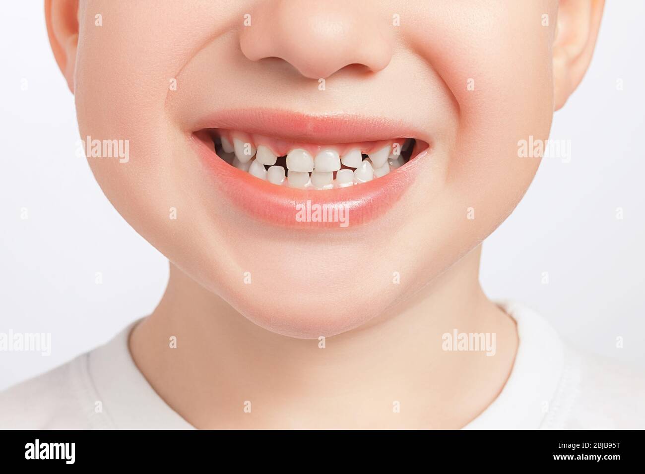 Closeup of child milk teeth with gaps between them. Diaeresis, diastema