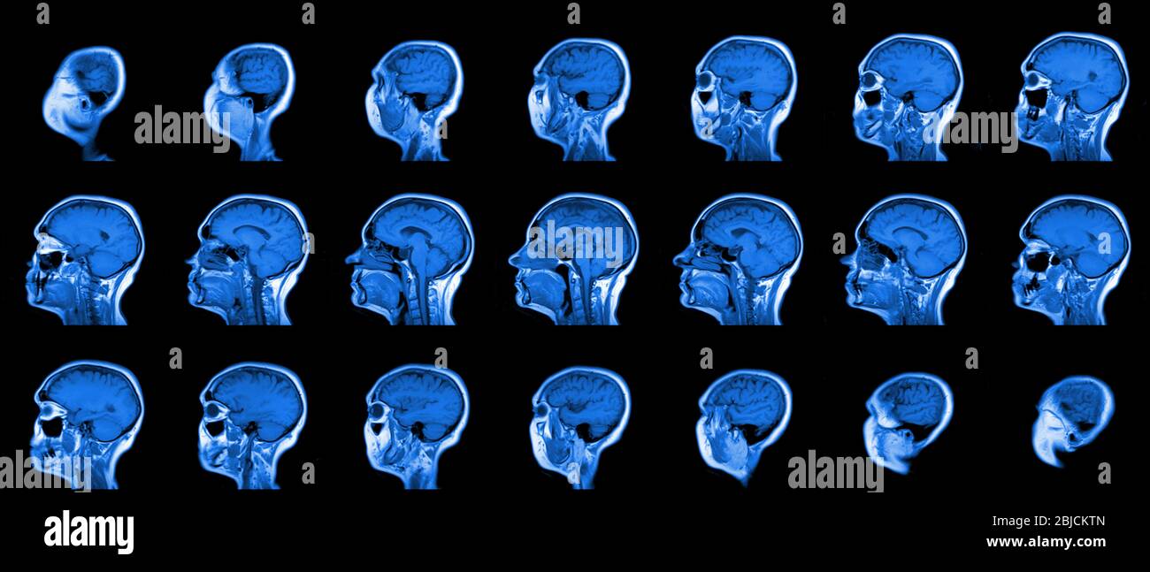 set of serial MRI scans of sixty years old caucasian female head in sagittal or longitudinal plane Stock Photo