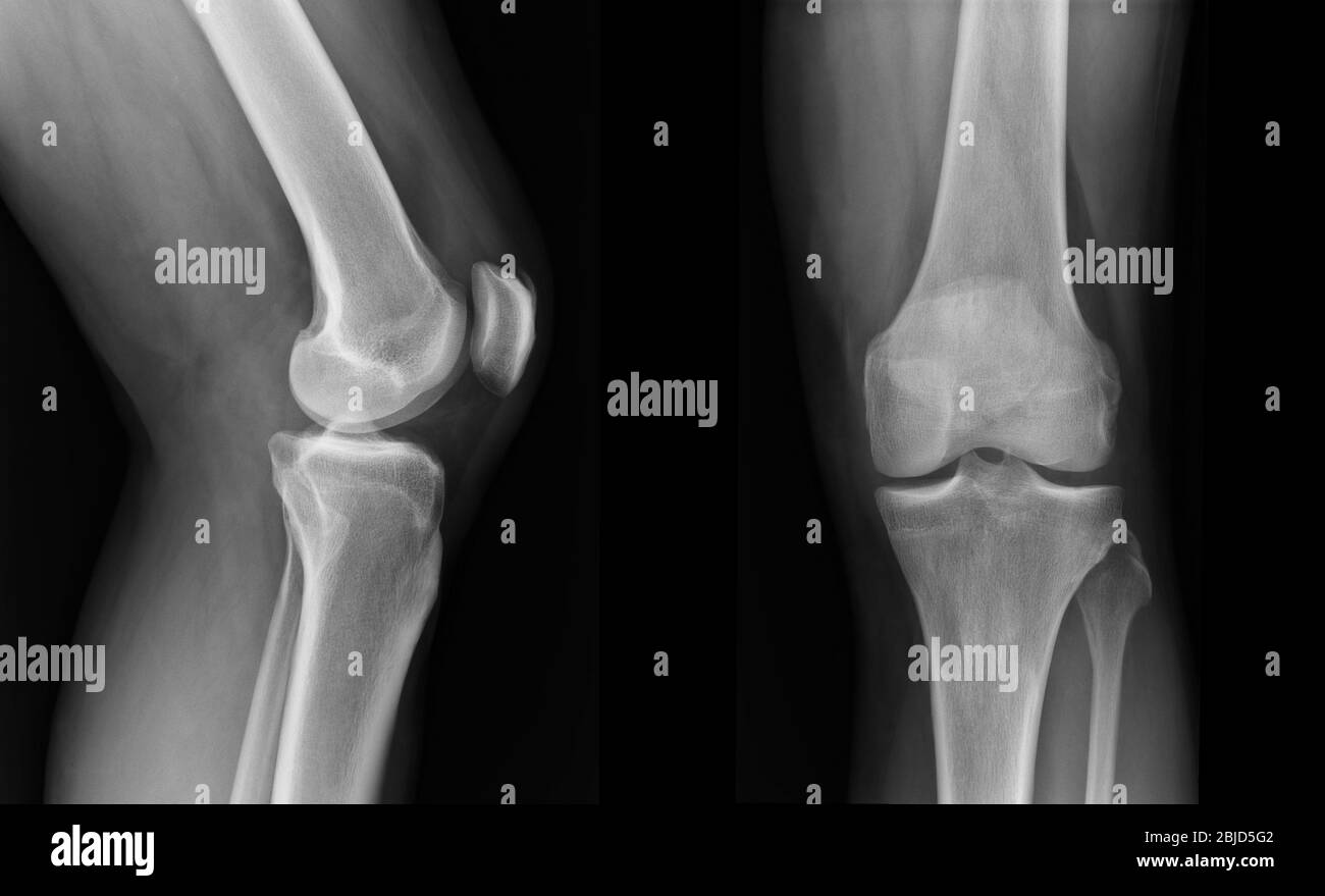 X-ray knee radiograph show state of injury Stock Photo