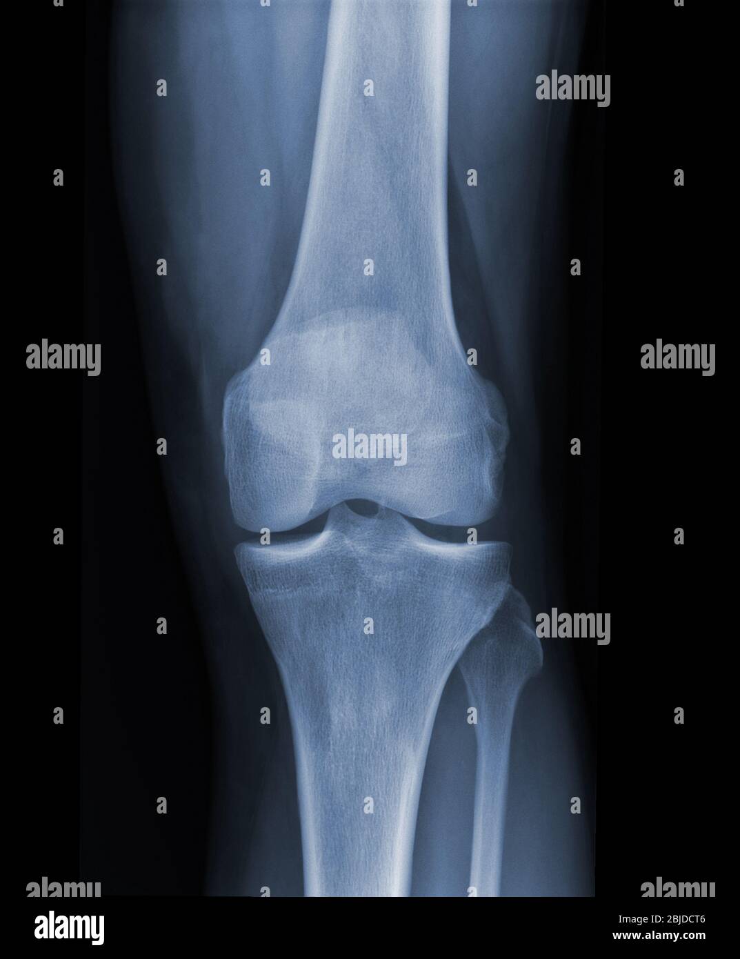 Xray knee radiograph show state of injury Stock Photo Alamy