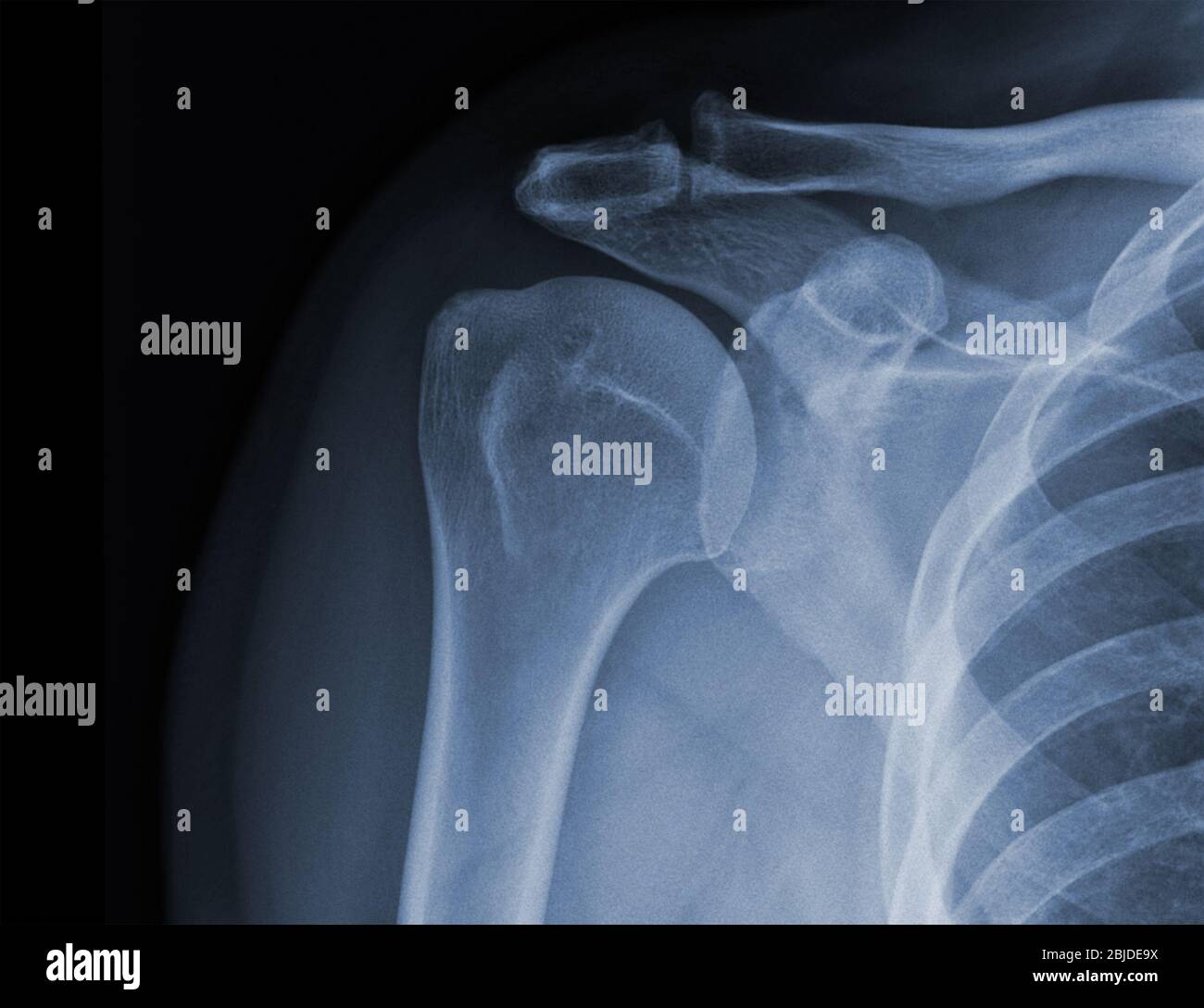 Xray shoulder radiograph show state of injury Stock Photo Alamy