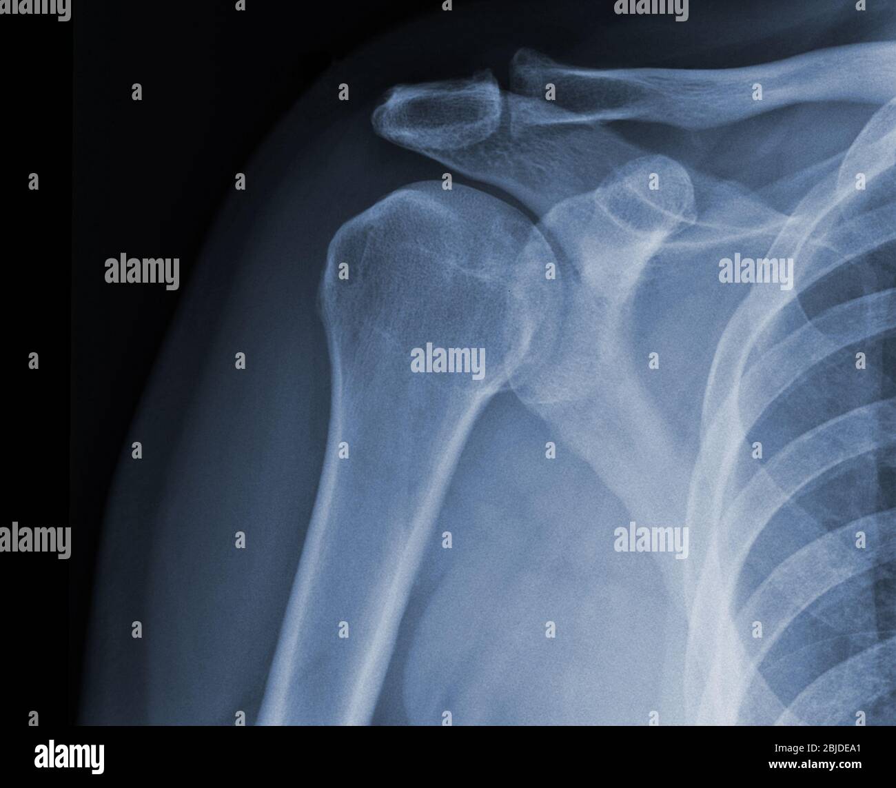 X-ray shoulder radiograph show state of injury Stock Photo
