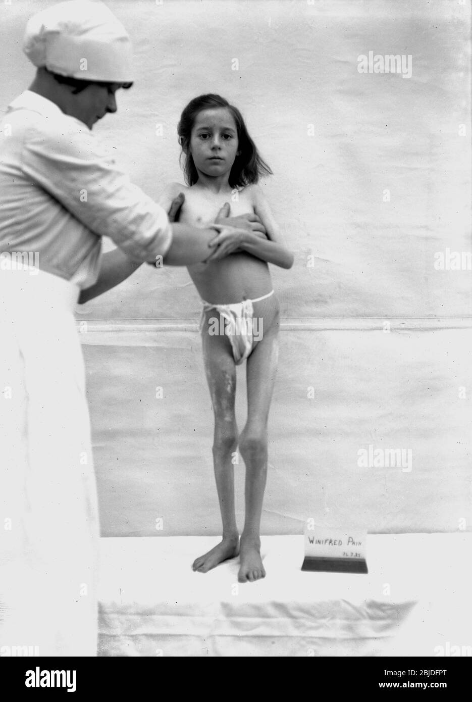 Children with Rickets young girl being treated at a sanitorium in Hampshire England in 1925. treatment medication health malnutrition poor Britain British care nursing1930s light therapy Stock Photo