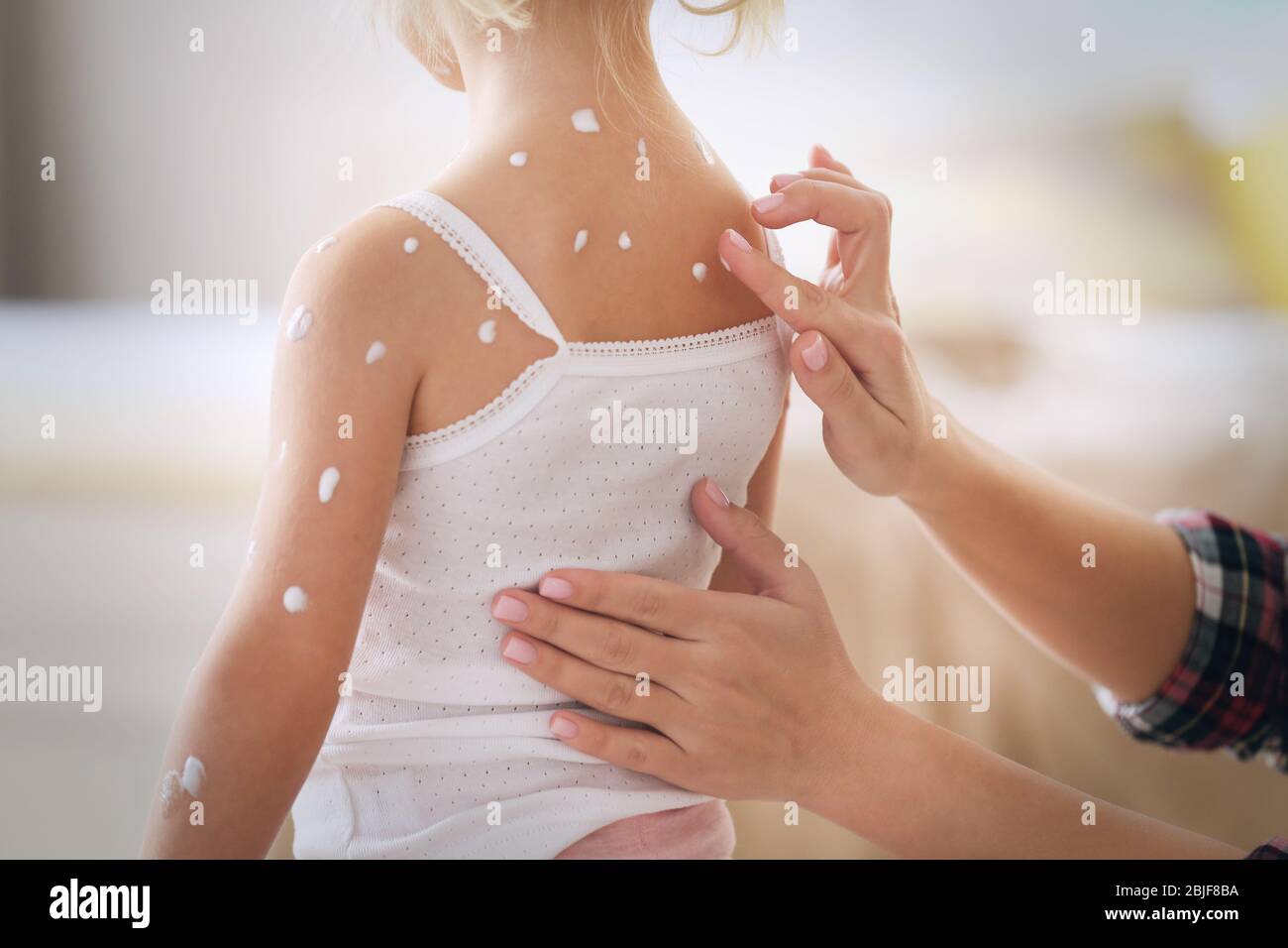 Female hands applying cream on little girl with chicken pox at home Stock Photo