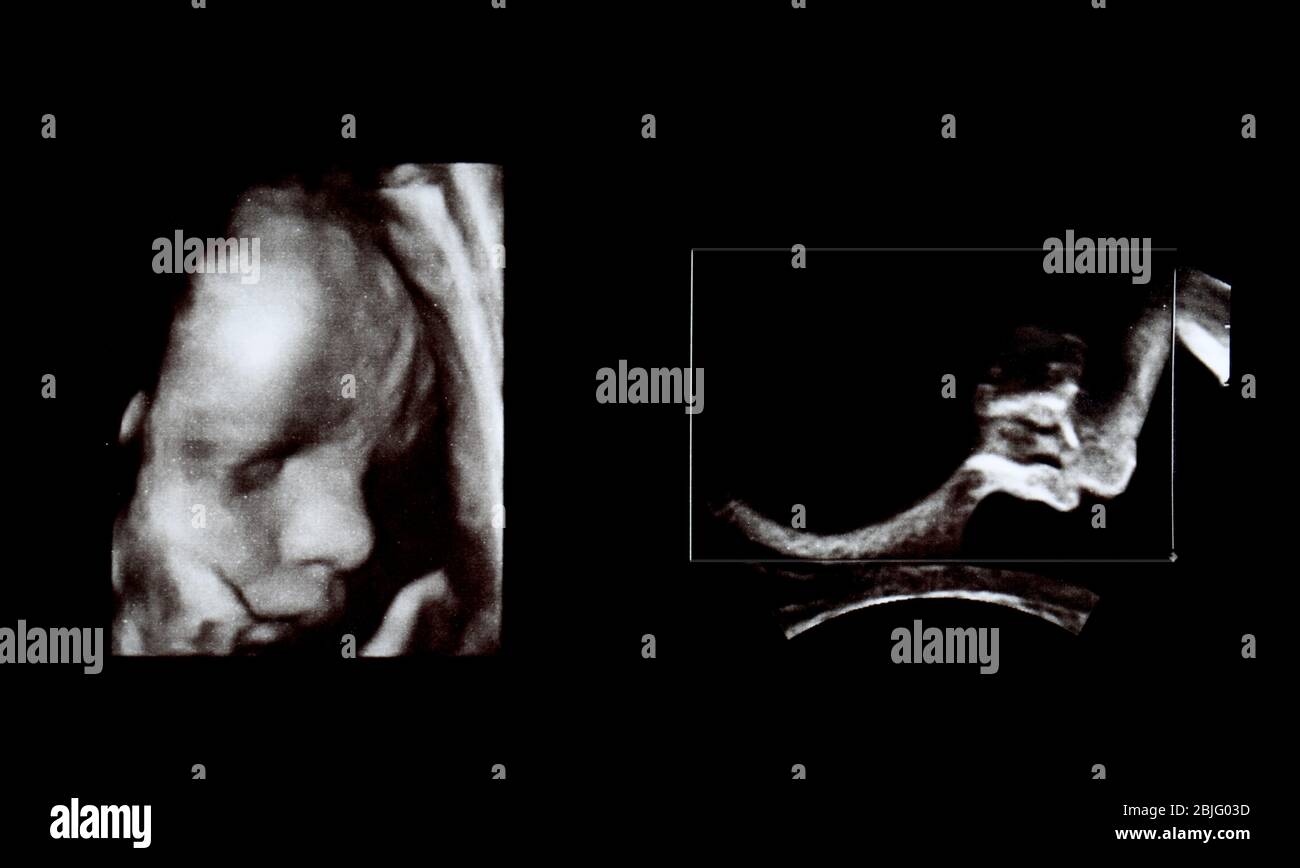 Ultrasound picture of baby, closeup Stock Photo