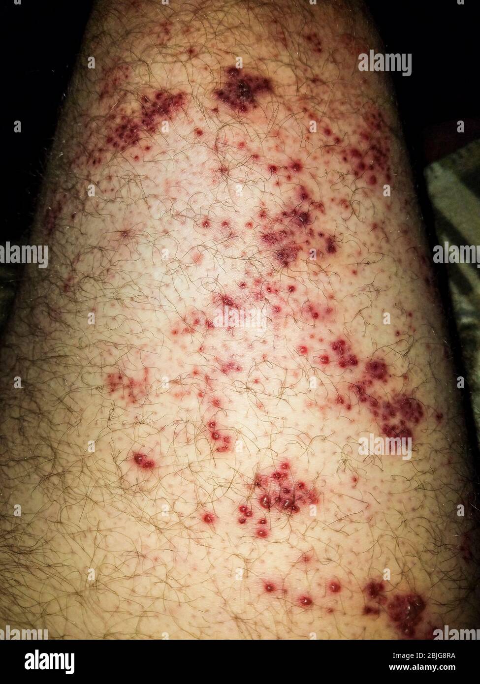 Shingles Herpes Zoster Stock Photo
