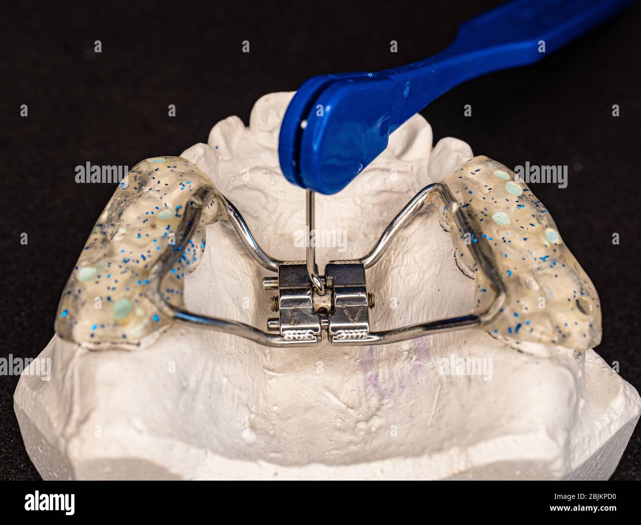 Setting of orthodontic appliance. Colored and glittered upper teeth