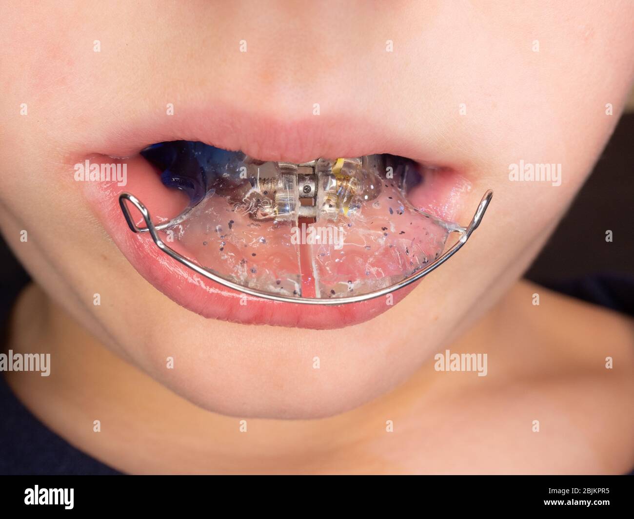 Blue dental braces in chuldren mouth. Removable orthodontic appliance