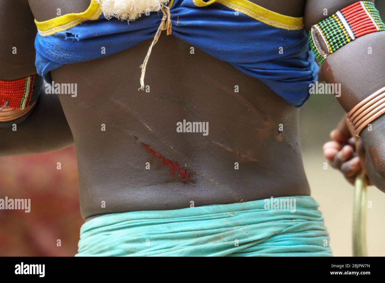 The raw scars on a Hamar woman's back after being whipped at a 'Jumping of the Bull' ceremony. Photographed in the Omo River Valley, Ethiopia Stock Photo