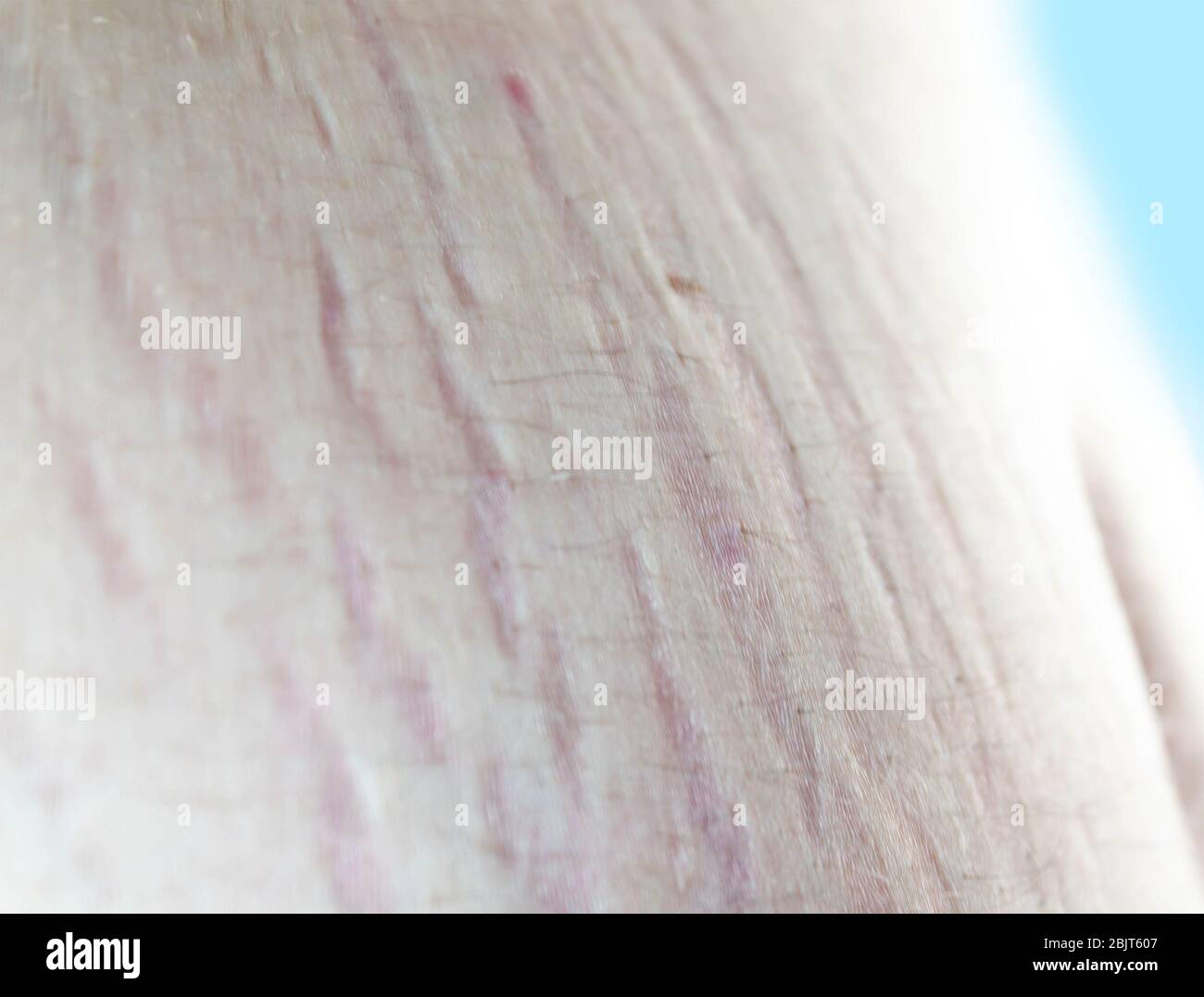 Stretch marks on the belly near the belly button. close up Stock Photo