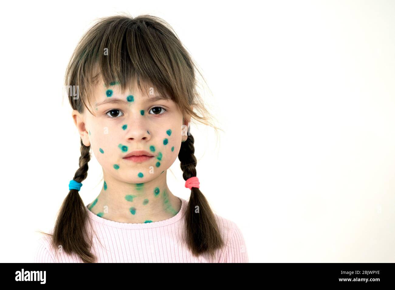 Child girl covered with green rashes on face ill with chickenpox, measles or rubella virus. Stock Photo