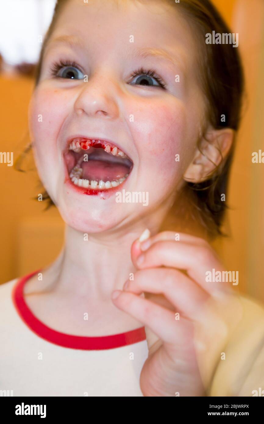 Pulled tooth blood hi-res stock photography and images - Alamy