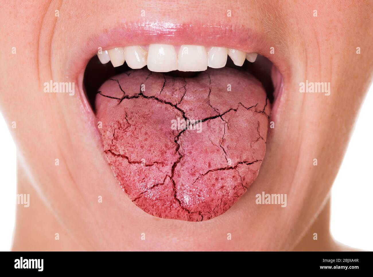 Woman Mouth And Broken Tongue With Cracks Stock Photo