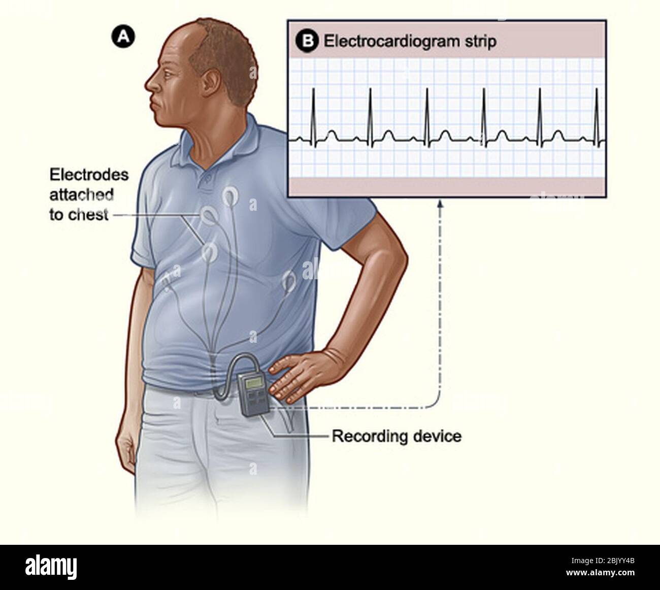 Смэкг что это. Схема суточного мониторирования ЭКГ. Холтер артериального давления. Холтеровское мониторирование. Суточное мониторирование ЭКГ по Холтеру.