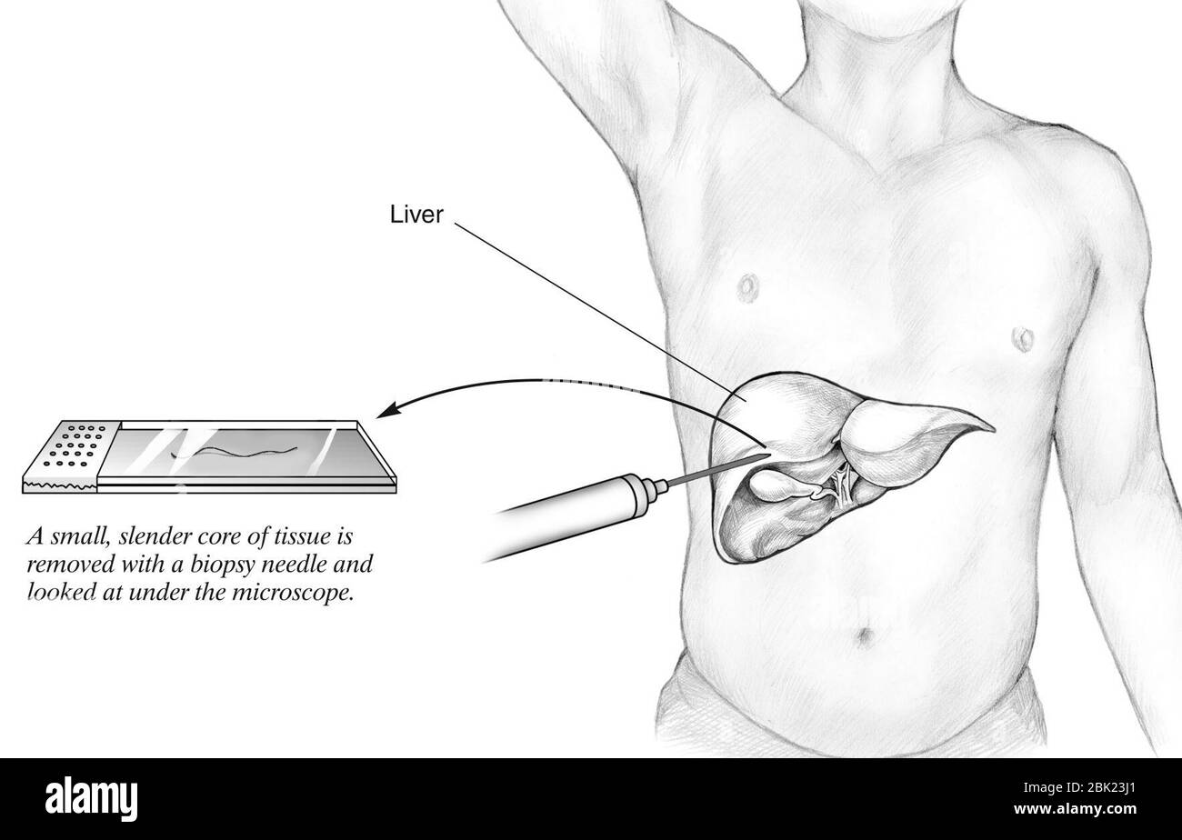 Human liver biopsy sample Stock Photo Alamy