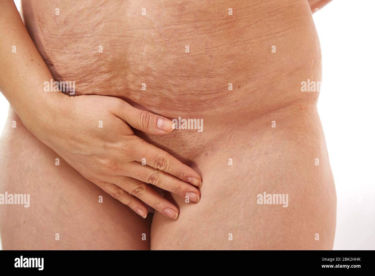 belly of a 40 year old woman with postpartum stretch marks close up Stock Photo