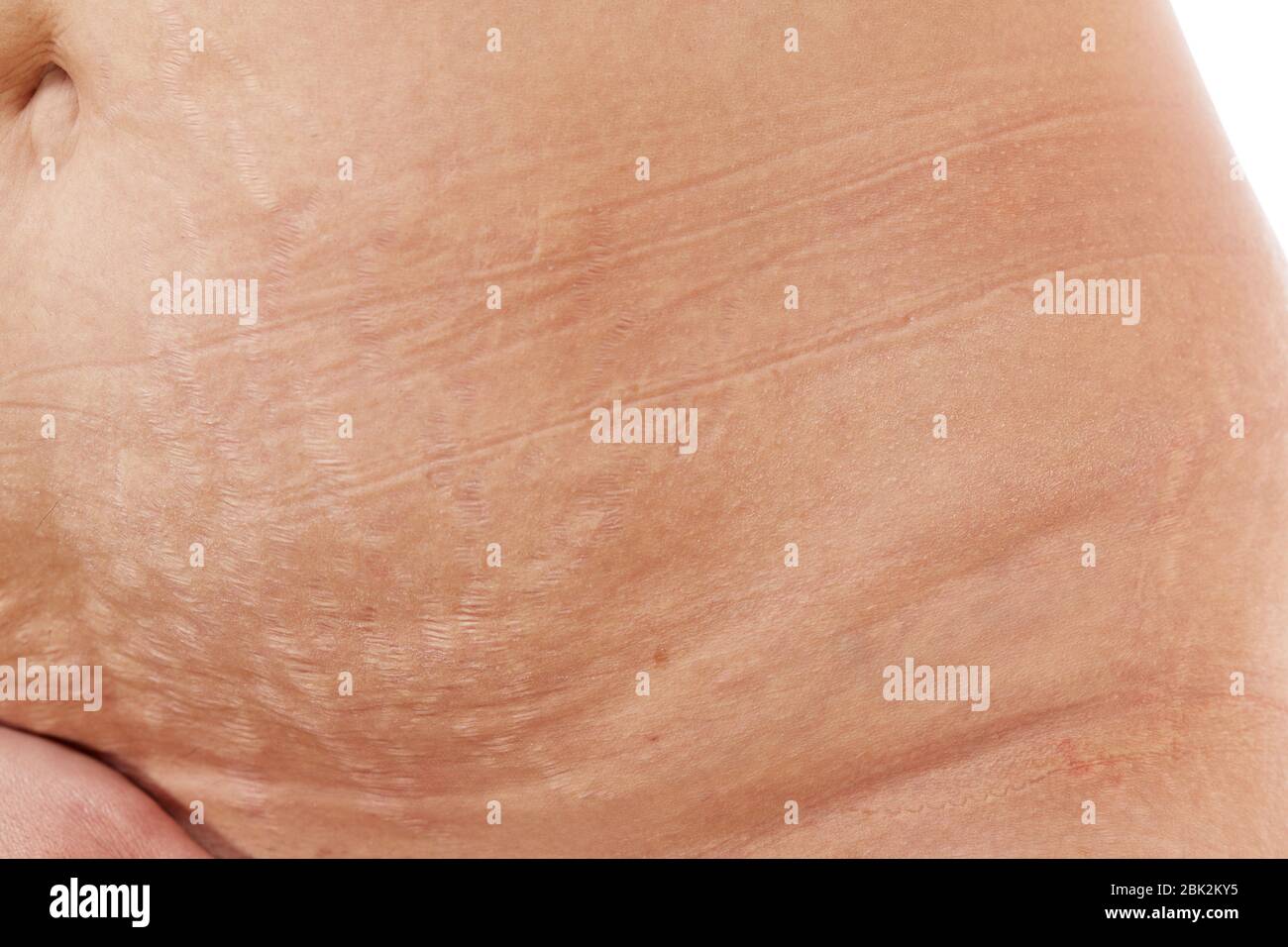 belly of a 40 year old woman with postpartum stretch marks close up Stock Photo