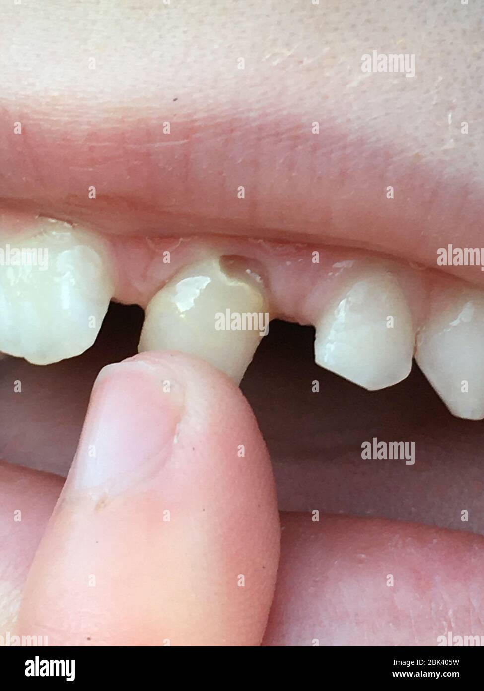 Do Canine Teeth Fall Out do-canine-teeth-fall-out